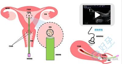 宫腔镜风险有多大？做泰国试管婴儿前需要做吗？