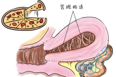 宫腔粘连是什么原因导致的？对试管成功率有影响吗？