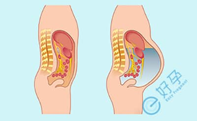 促排取卵后易出现腹水，做试管婴儿该如何避免的？
