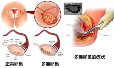 维生素D与试管成功率有什么样的关系？会影响着床吗？