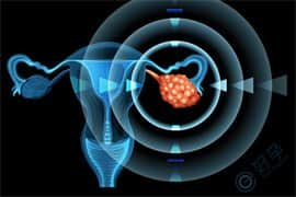 去泰国做试管婴儿，会发生卵巢过度刺激综合征吗？