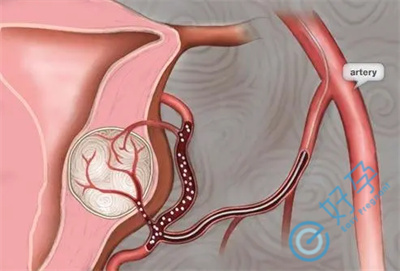 患有子宫肌瘤做试管婴儿会影响取卵吗？