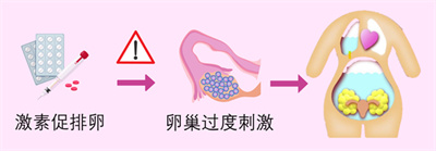 做试管婴儿，轻松四步避开卵巢过度刺激综合征