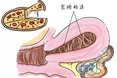 腔粘连可以做试管婴儿吗？试管之路的“隐形障碍”与“突破策略”