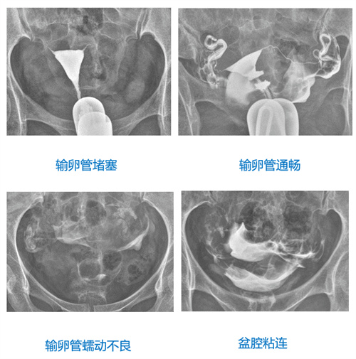 试管都要做输卵管造影吗？快来看看答案！