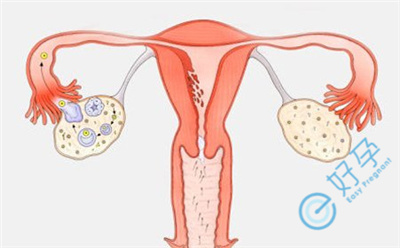 多囊卵巢怀孕的秘诀——做试管婴儿：开启生育新希望