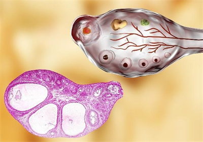 试管婴儿科普：80%的原发性不孕，竟是因为卵泡不好！