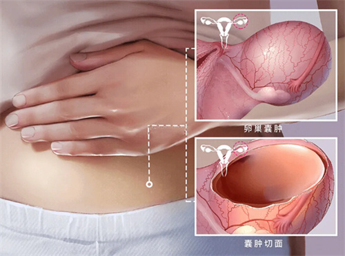 计划做试管婴儿：B超显示有卵巢囊肿怎么办？